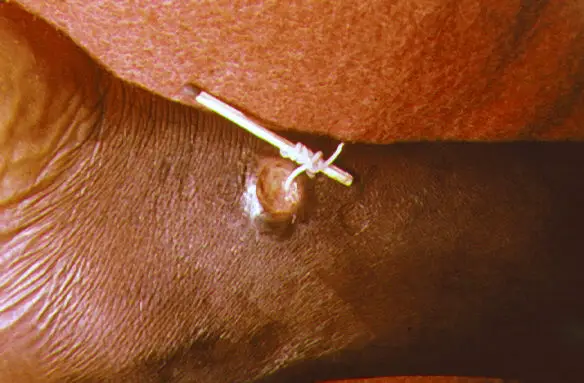 Guinea Worm Disease is one of the most horrifying parasites on the planet. 