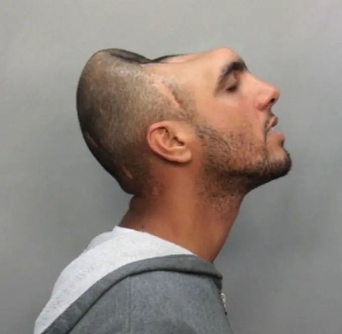 Man with half a head Carlos 'Halfy' Rodriguez - 10 real people you have to see to believe.