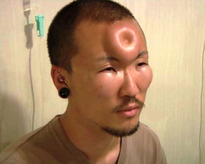Bageling is a popular body modification in Japan - 10 Most Insane Body Modifications You Just Have To See