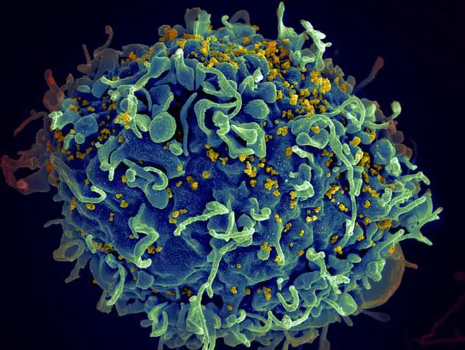 The AIDS virus through a microscope.