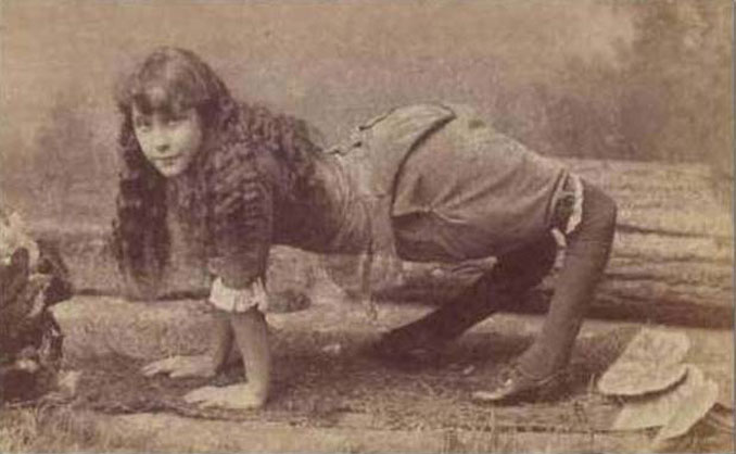 A photo of Ella Harper, a girl that had backwards knees.